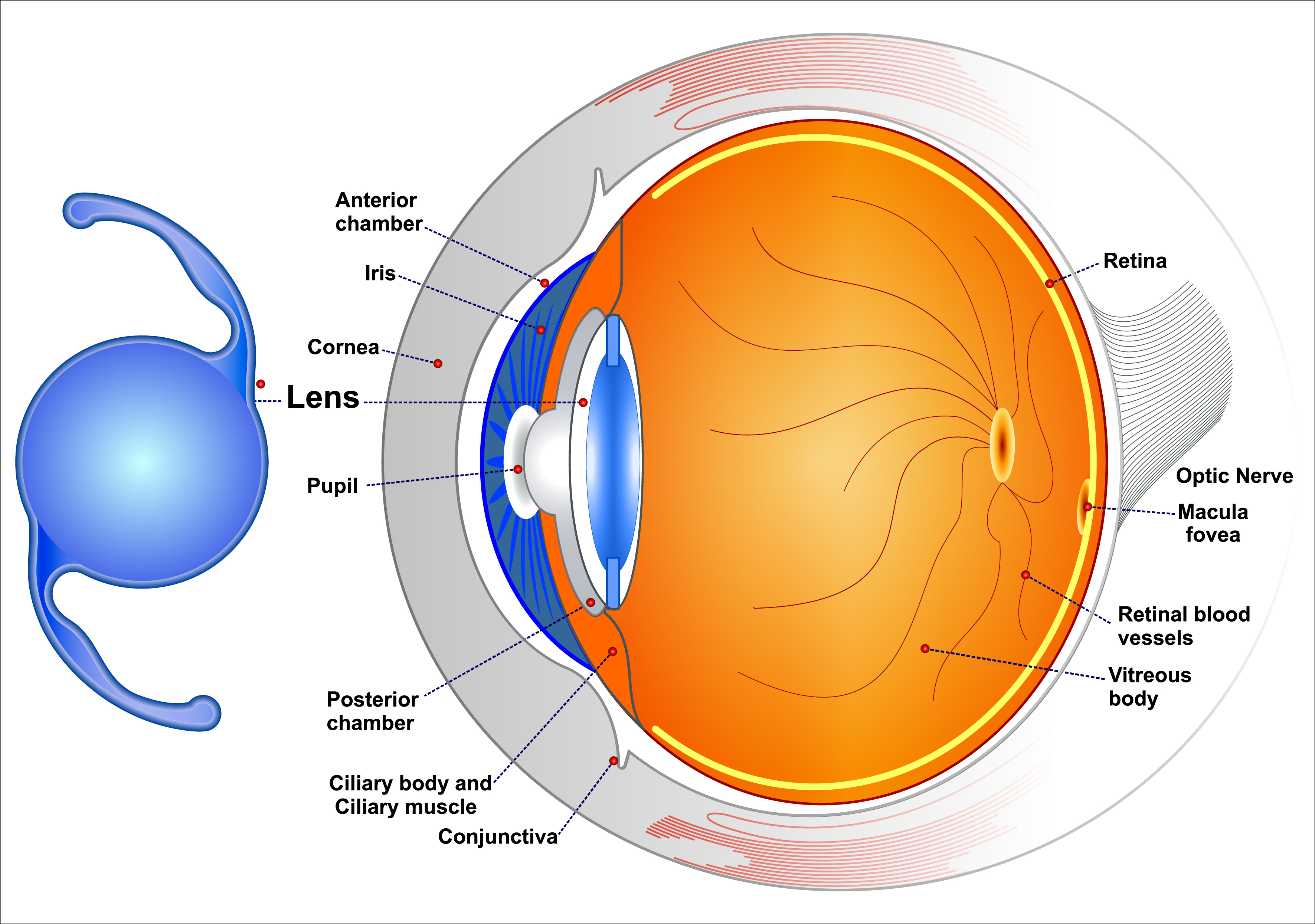Intraocular Lenses (IOLs)