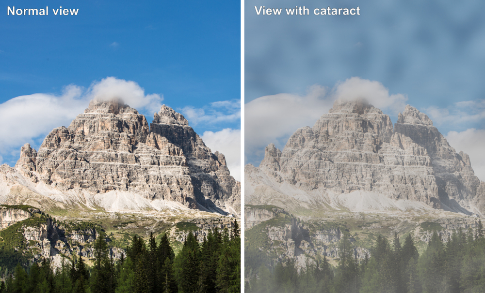 Normal vision versus cataract