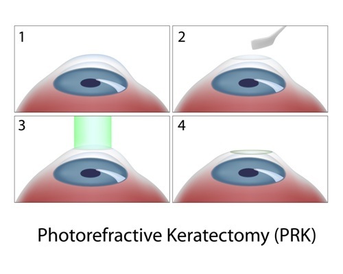 Photorefractive Keratectomy (PRK)