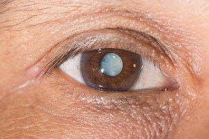 Cataract Surgery