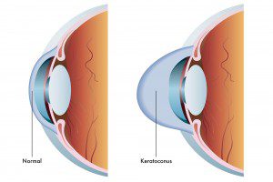 Keratoconus Treatments