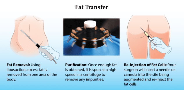 Fat transfer butt lift