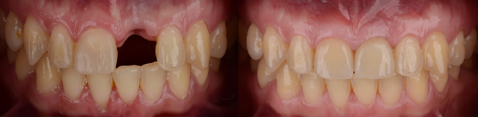 Dental Implants Before and After Photo