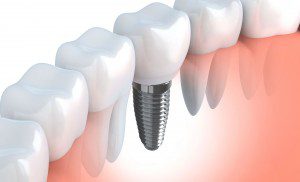 Dental Implants