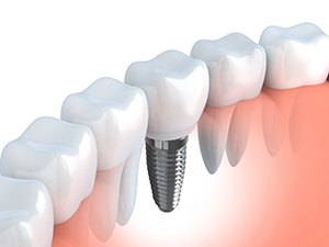 Dental Implant Procedure