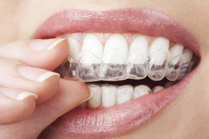 Invisalign Clear Aligners