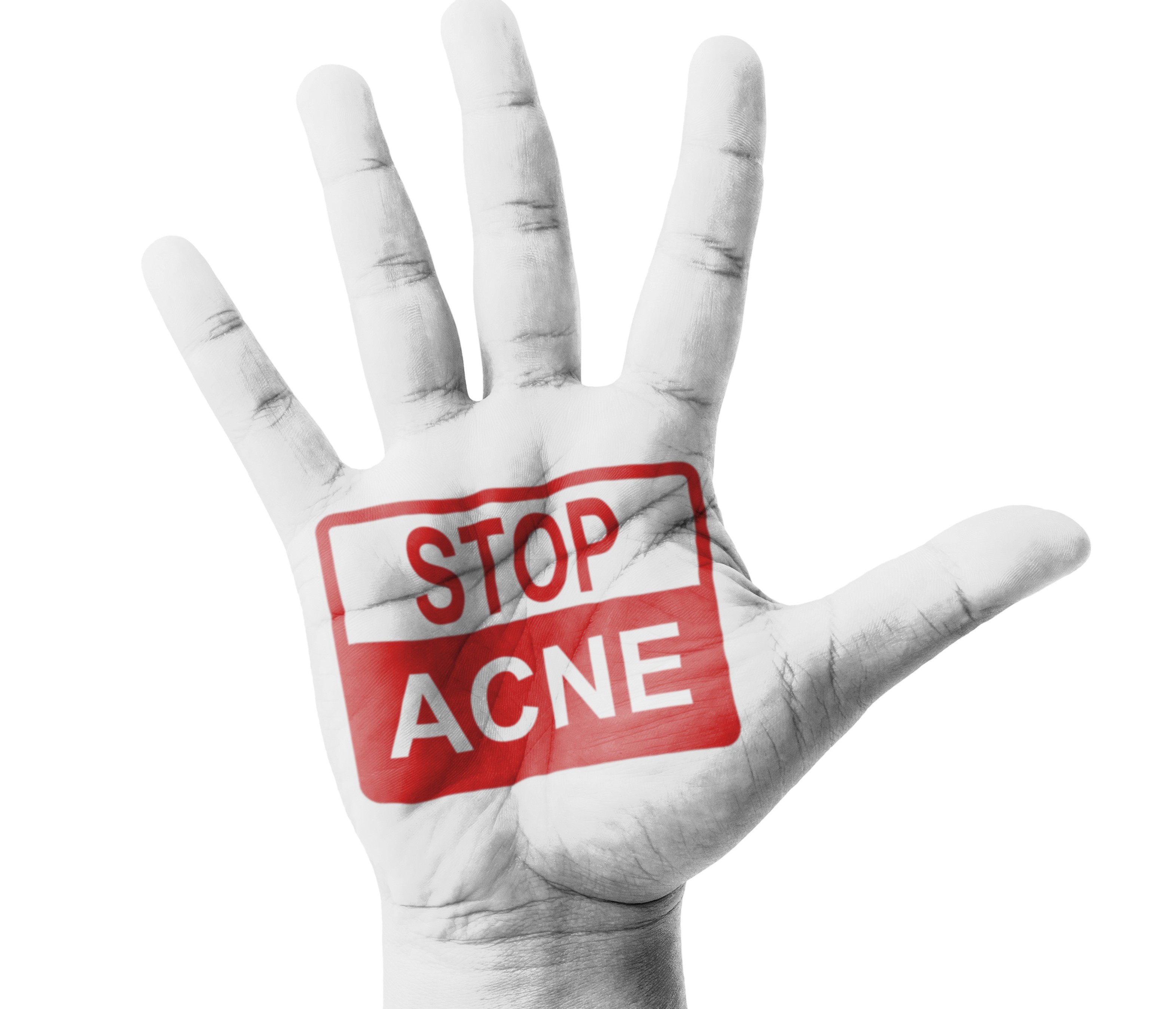 stop acne
