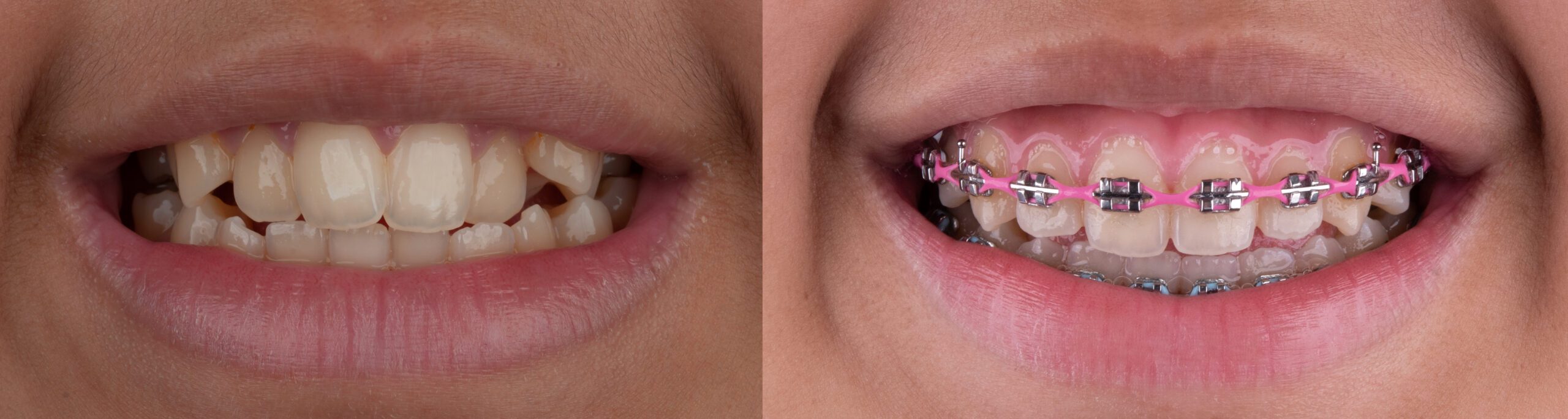 Dental Braces Before and After Photo