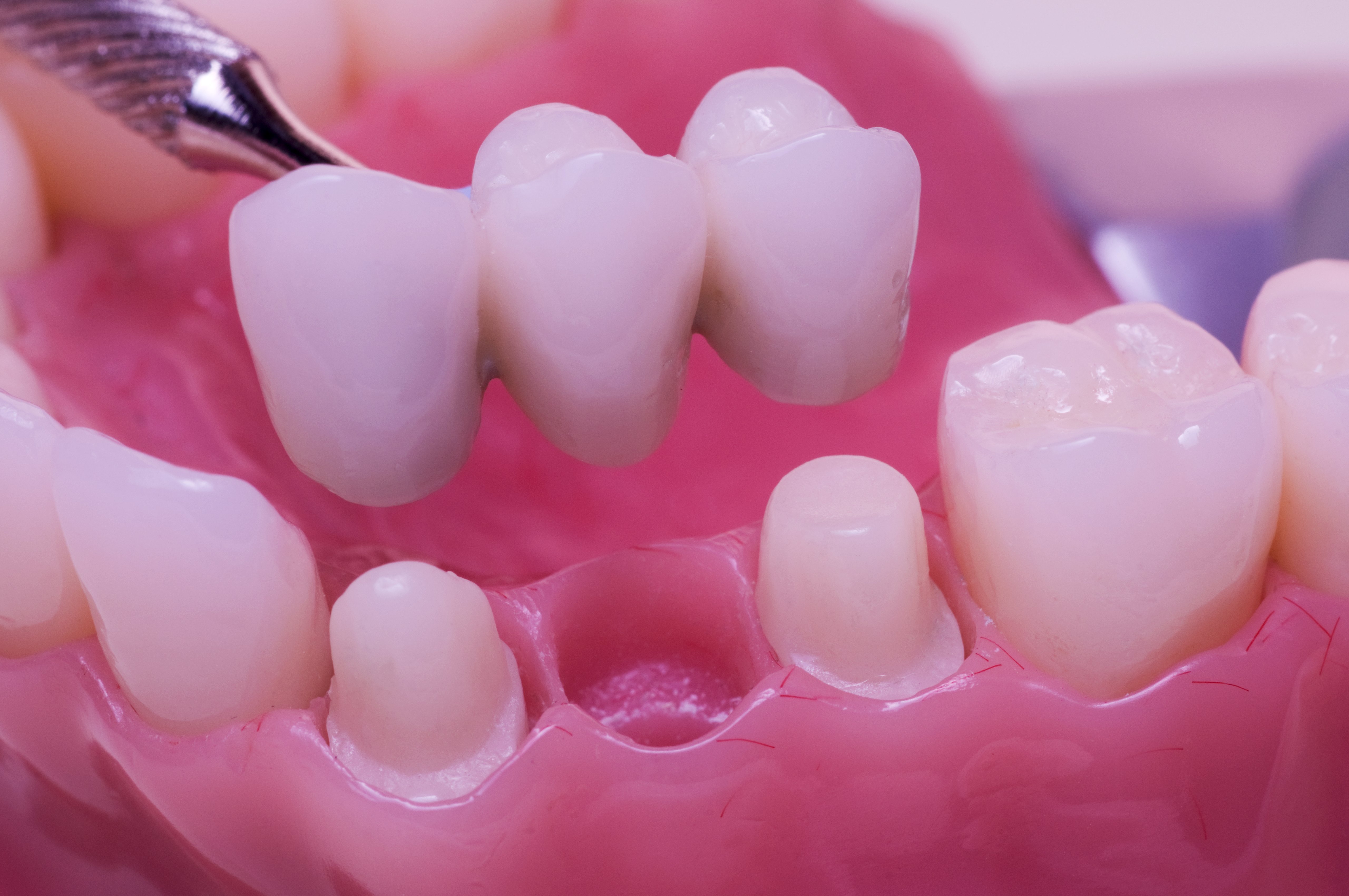 Dental Bridge Procedure