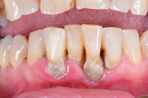 Gum Disease (Periodontitis)