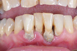 Gum Disease Treatment