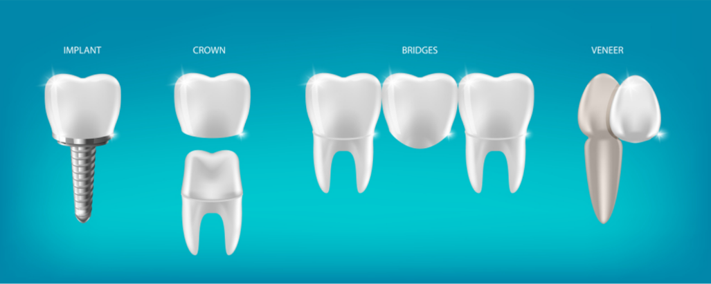 Tooth Restoration Options