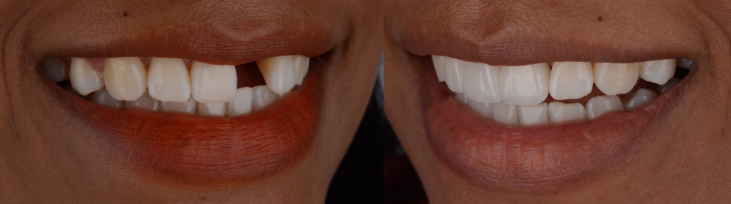 Dental Bridge Before & After Photo