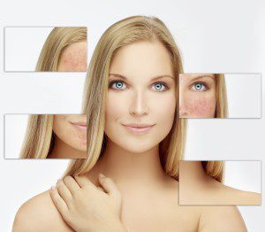 CO2 Laser Resurfacing