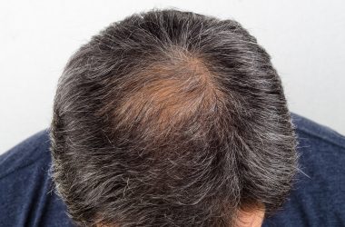 Hair Loss Treatments