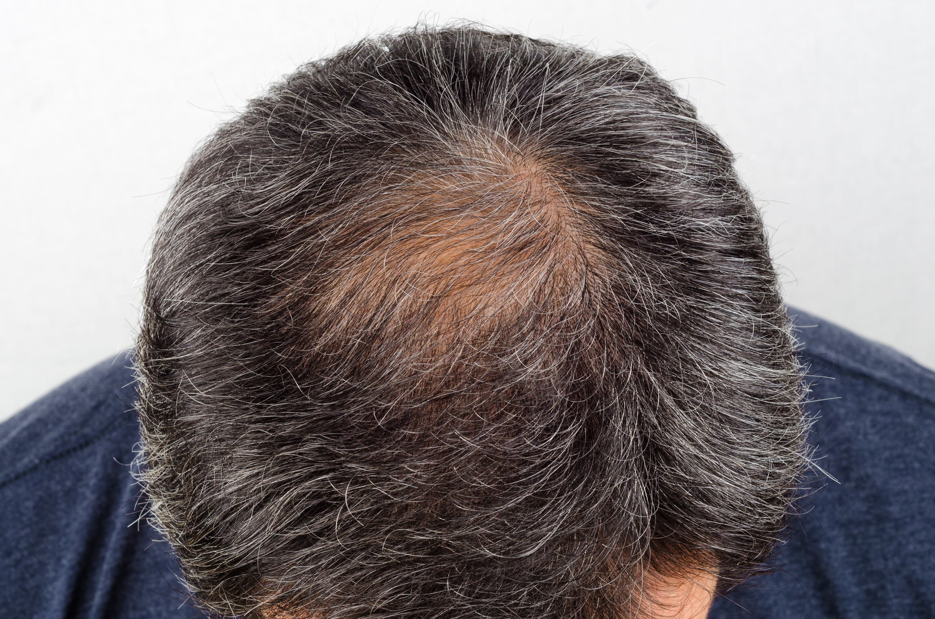 Hair Loss Treatments