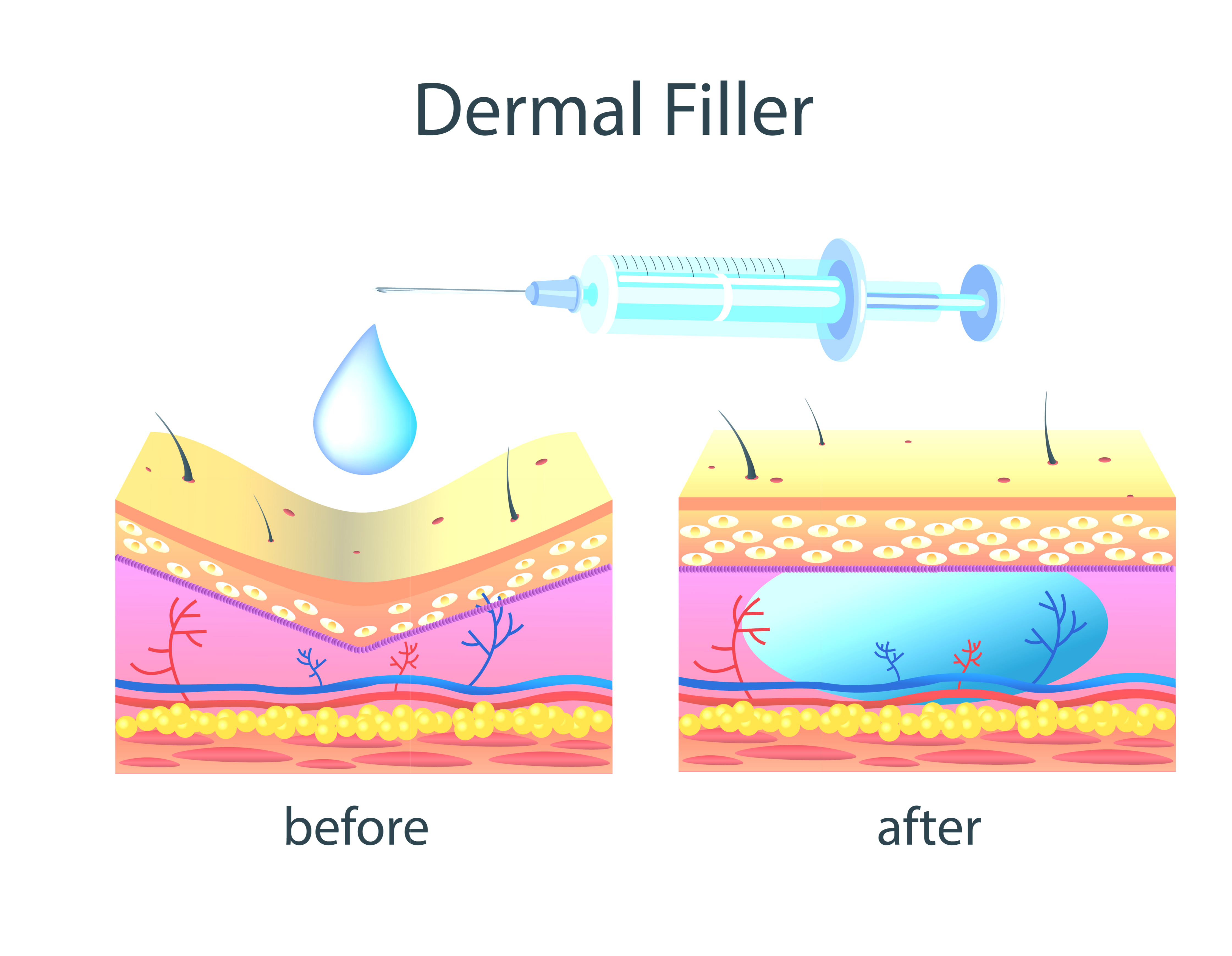 How Dermal Fillers Work