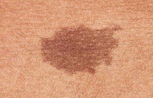 Hyperpigmentation Treatment