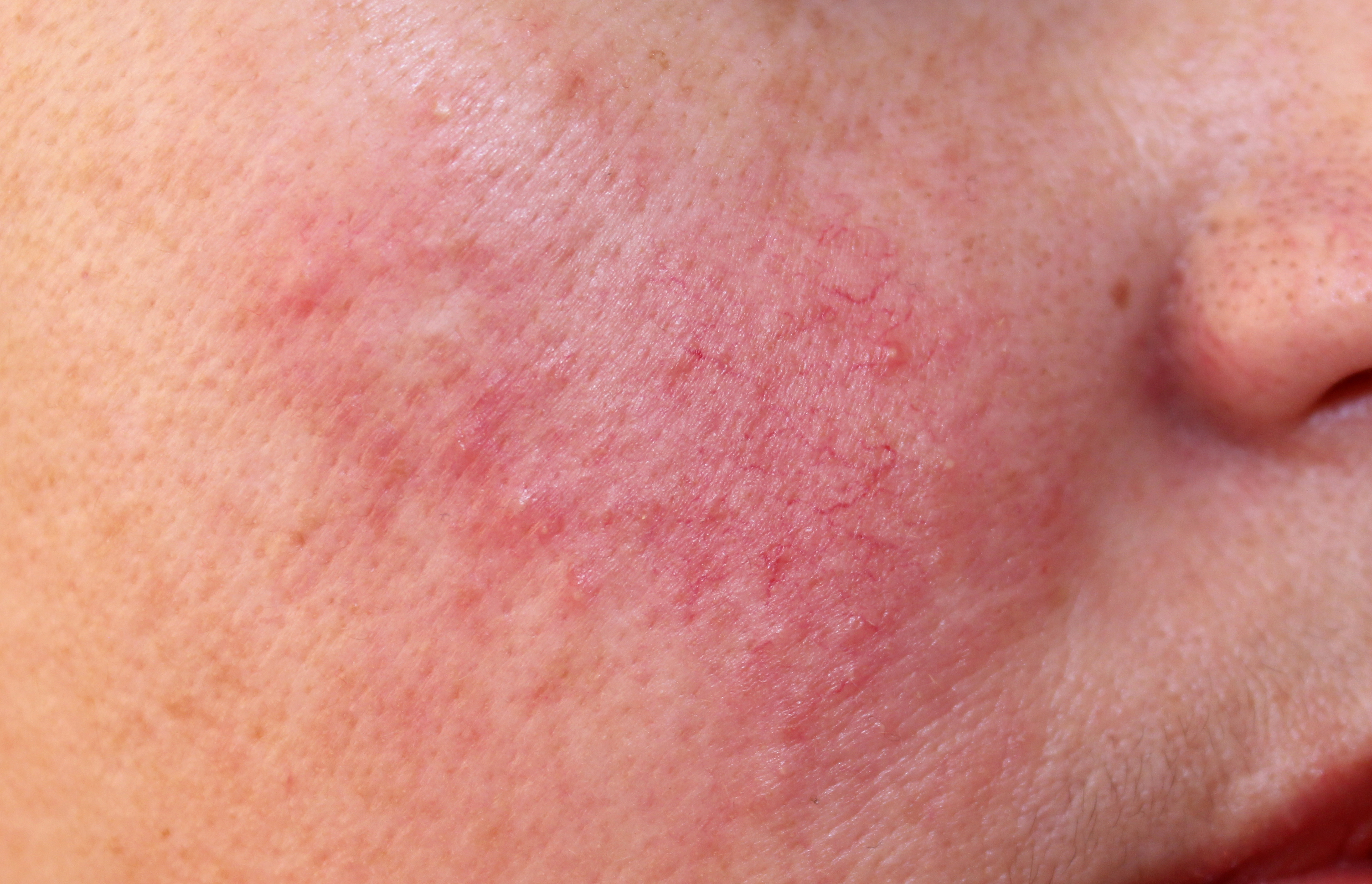 Rosacea Treatments