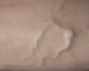 Varicose Vein Treatments