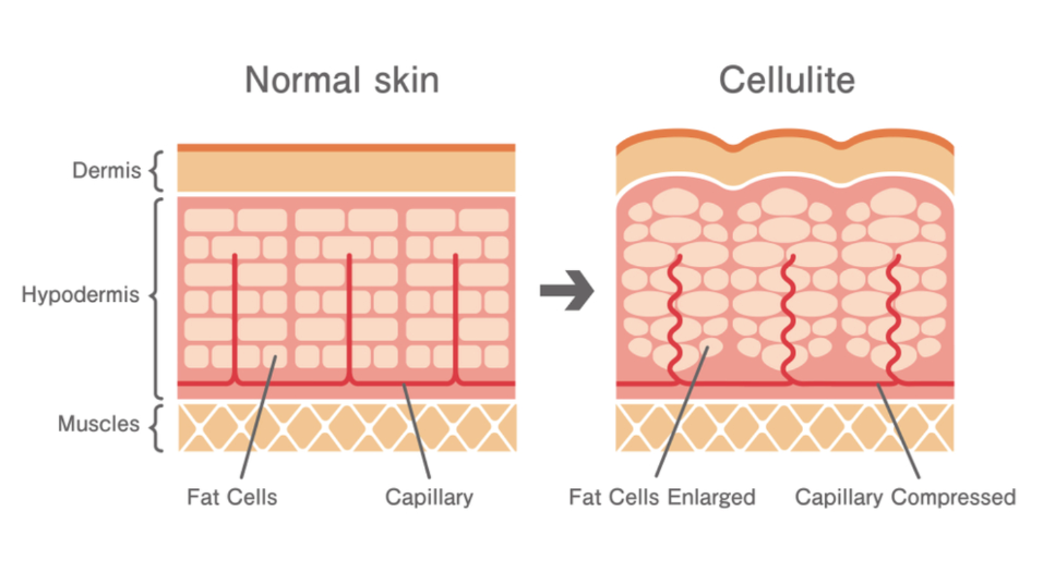 Cellulite Causes