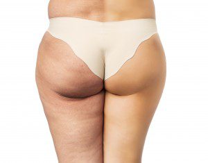 Cellulite Treatments