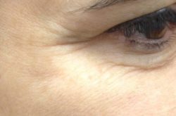 39 year old woman got Botox Injections in eye area
