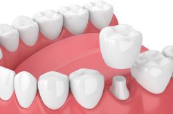 Dental Crown Procedure