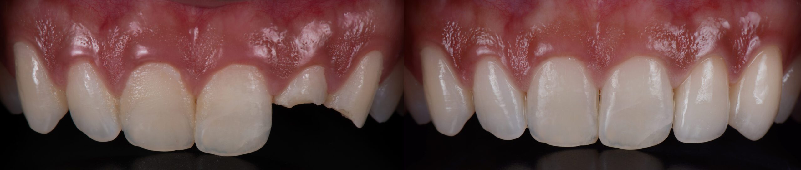 Dental Crown Before & After Photo