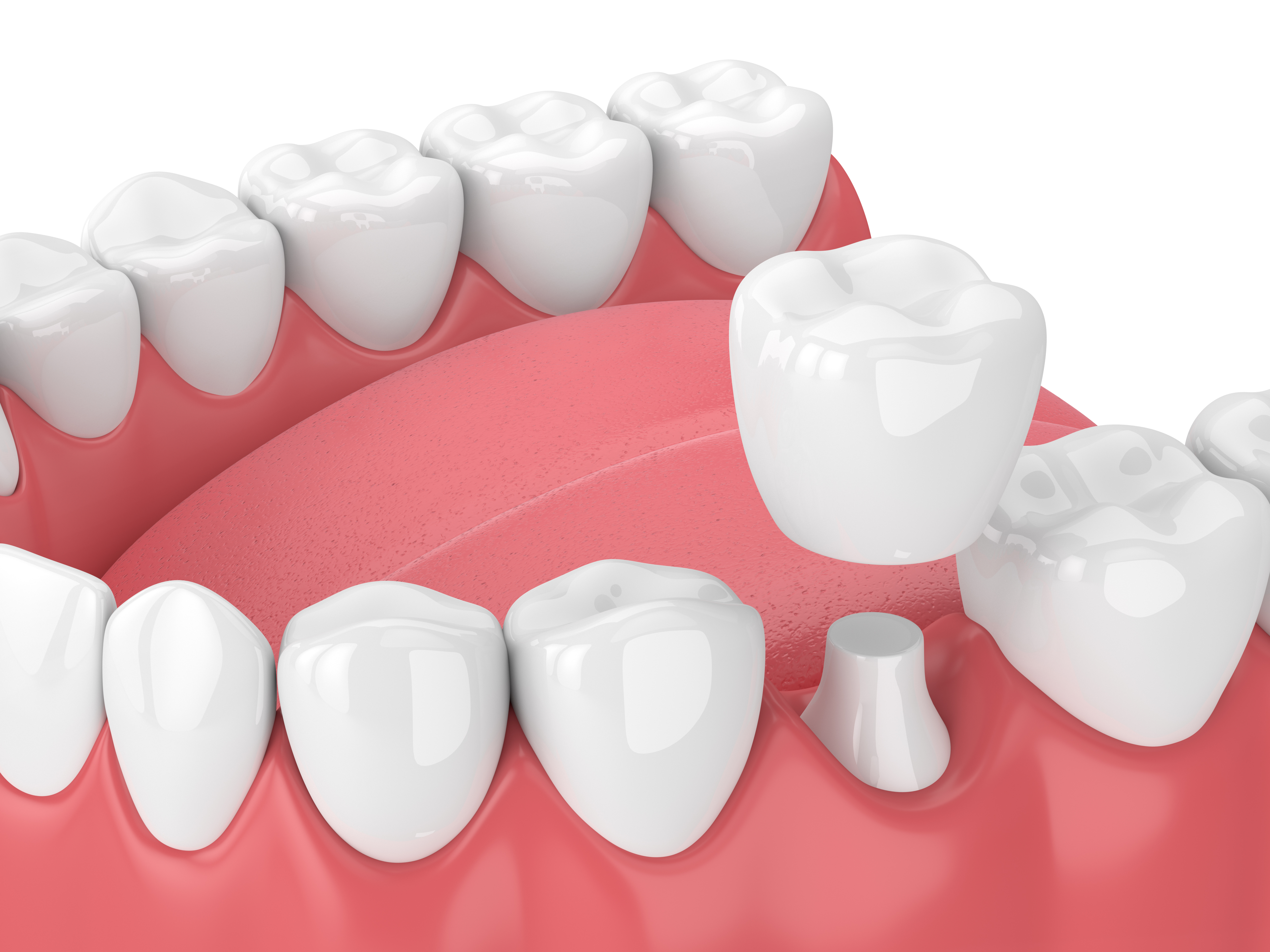 Dental Crowns (Cap)