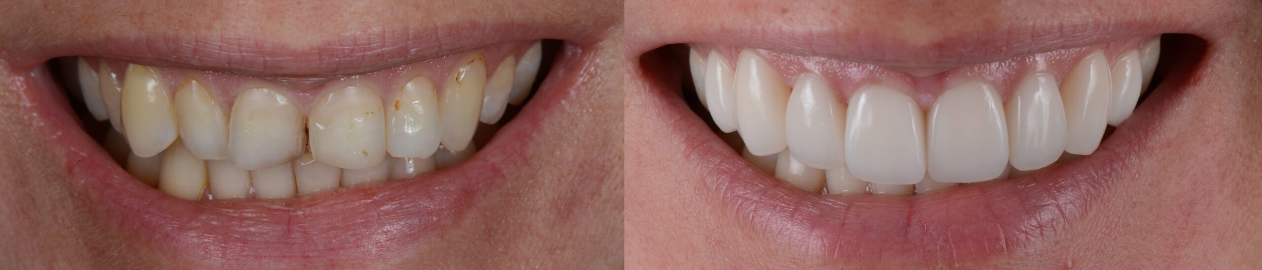 Dental Veneers Before and After Photo
